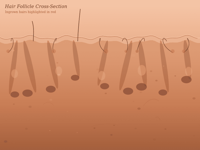 Ingrown Hairs Treatment UK: How to Get Rid of Them and When to See a Doctor
